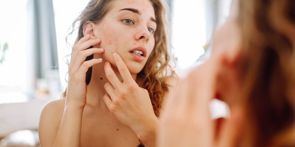 acne-prone woman acne-prone