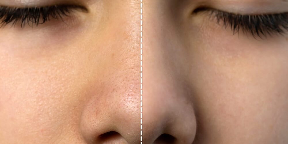 shrink pores before after