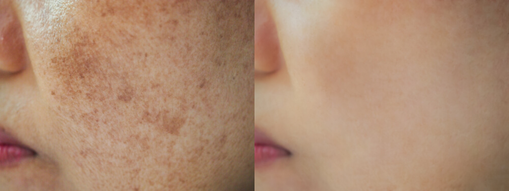 woman dark spots
