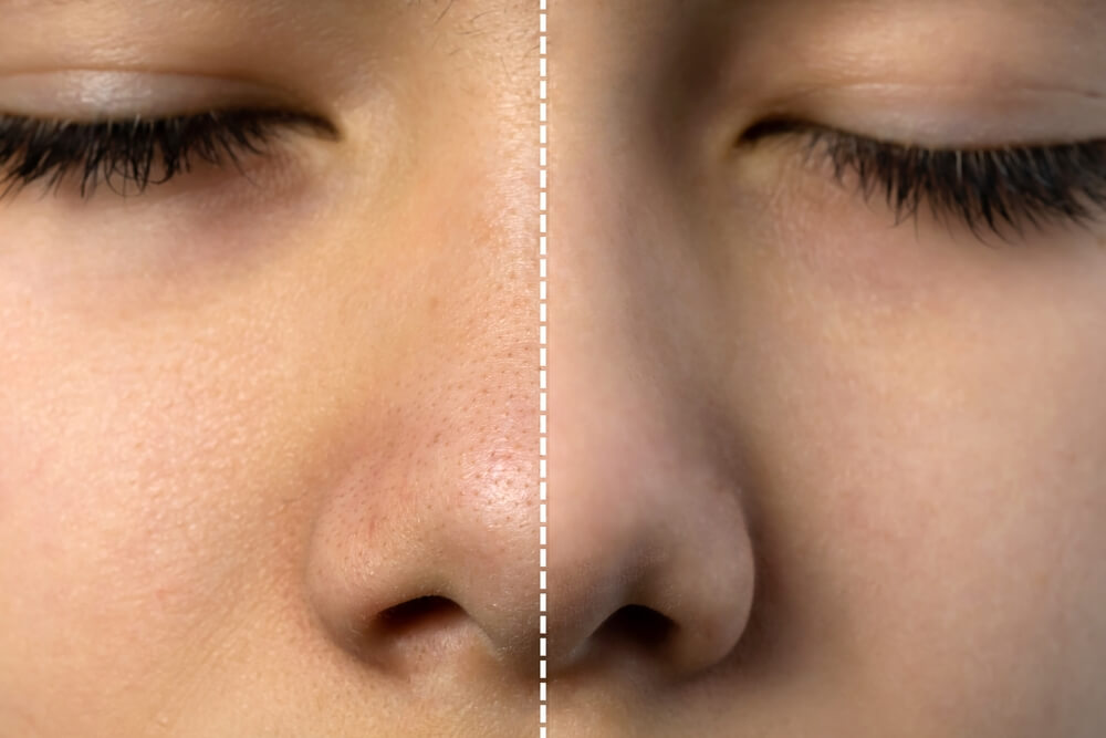 shrink pores before after